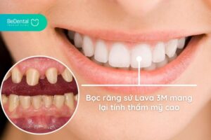 răng sứ lava 3m